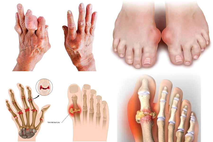 Is gout hereditary?